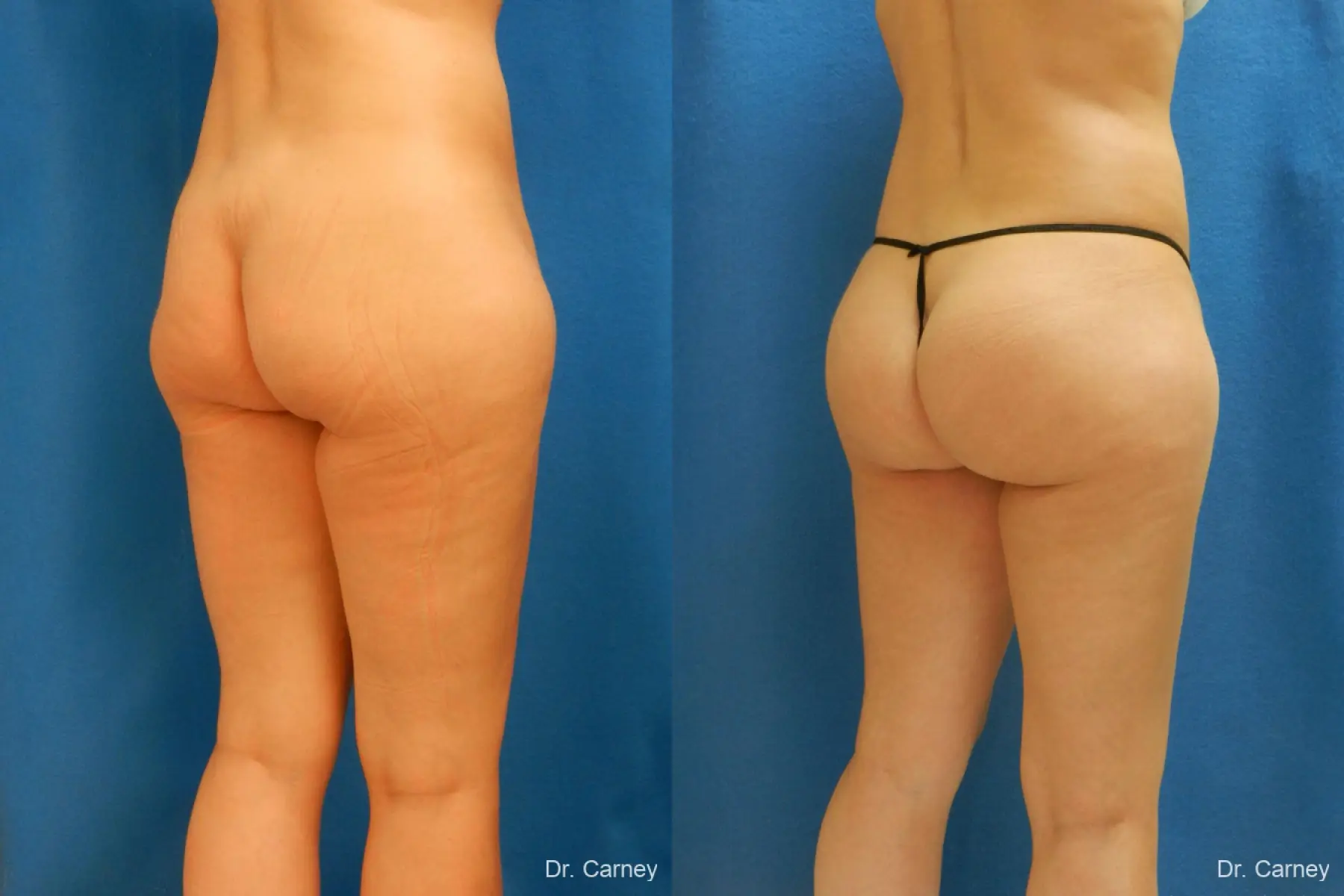 Brazilian Butt Lift: Patient 7 - Before and After 2