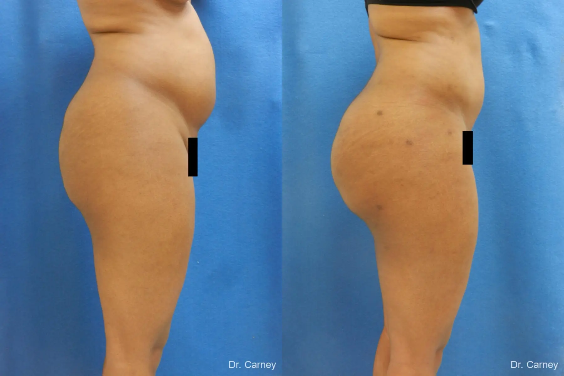 Brazilian Butt Lift: Patient 6 - Before and After 5