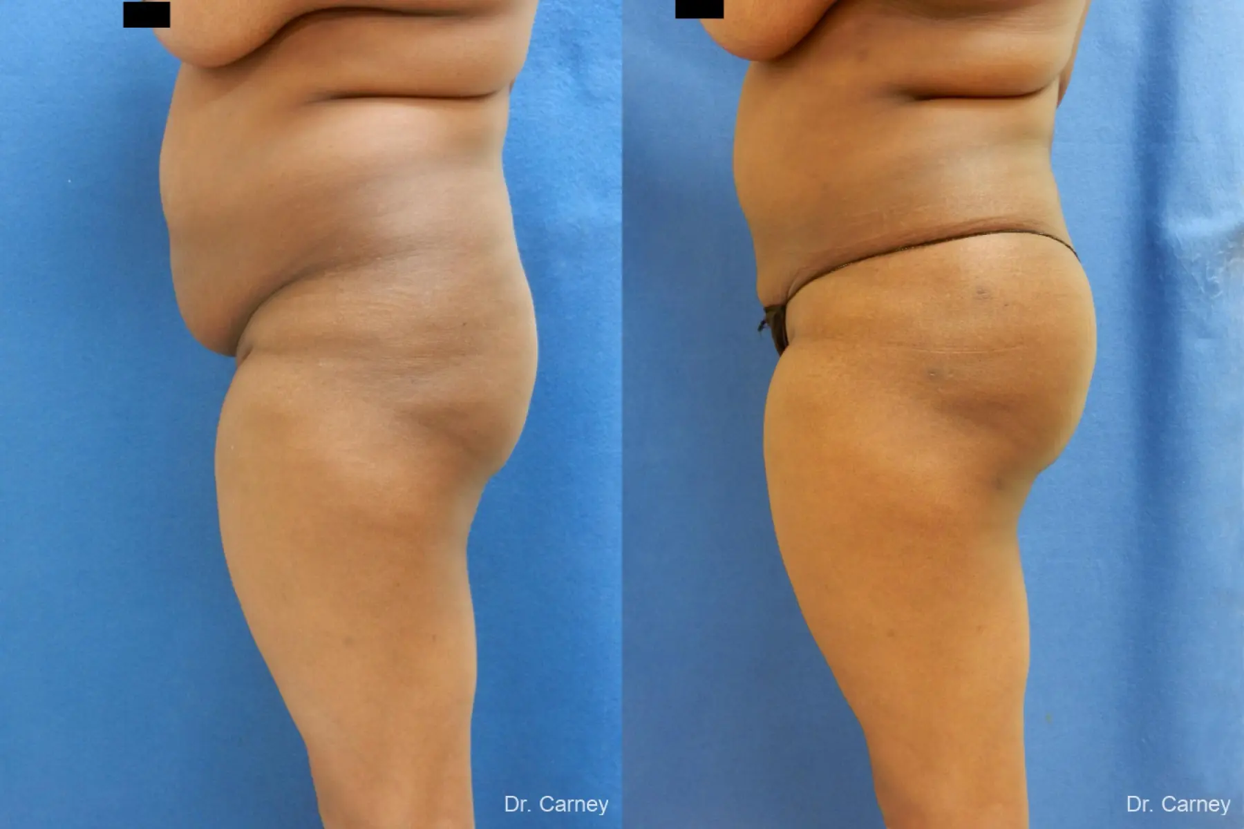 Brazilian Butt Lift: Patient 5 - Before and After  