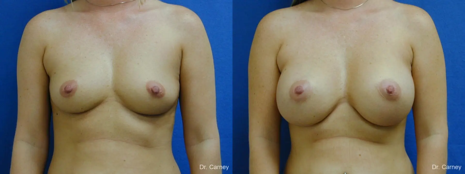 Virginia Beach Breast Augmentation 1192 - Before and After 1
