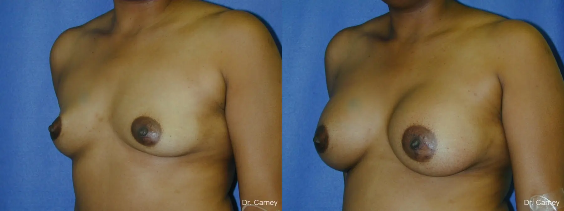 Virginia Beach Breast Augmentation 1091 - Before and After 3