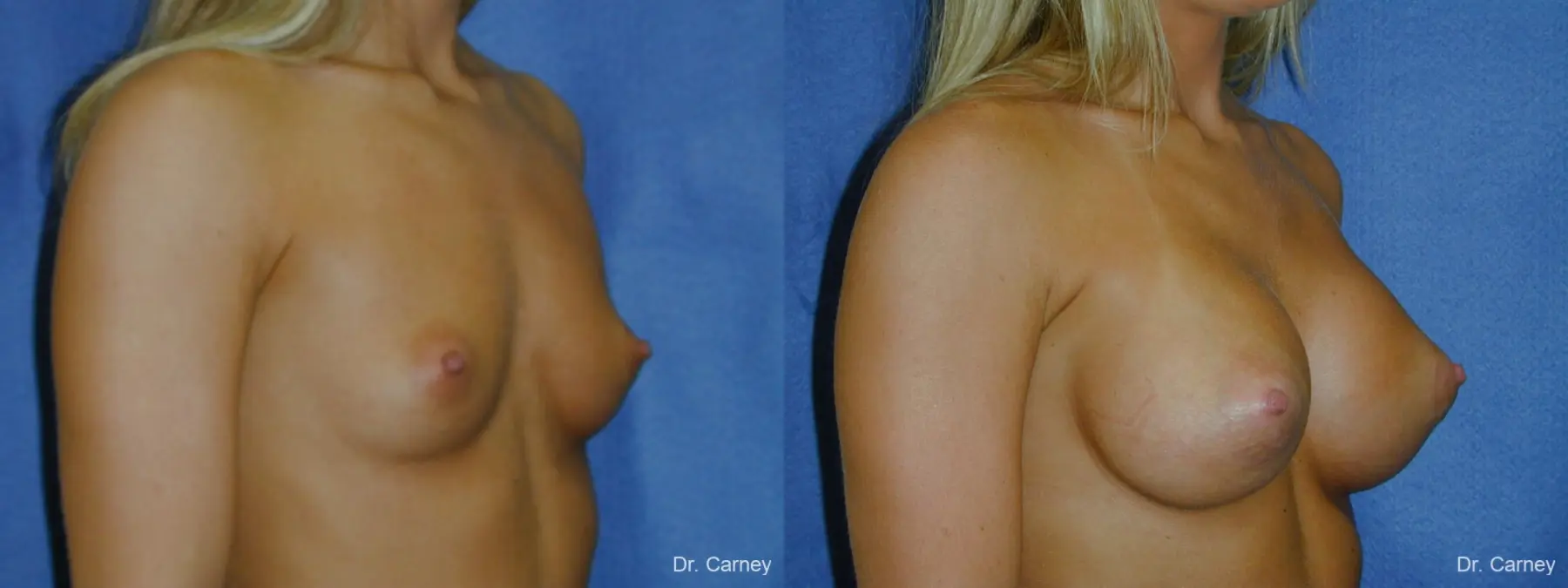 Virginia Beach Breast Augmentation 1193 - Before and After 2