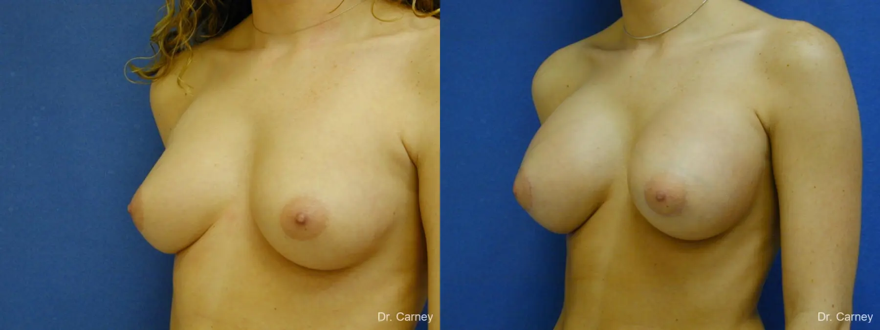 Virginia Beach Breast Augmentation 1089 - Before and After 2