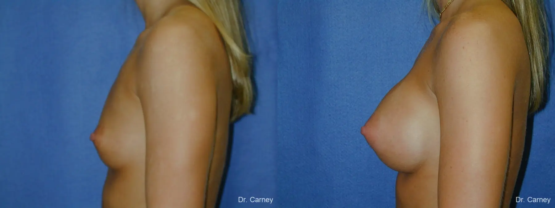 Virginia Beach Breast Augmentation 1193 - Before and After 3