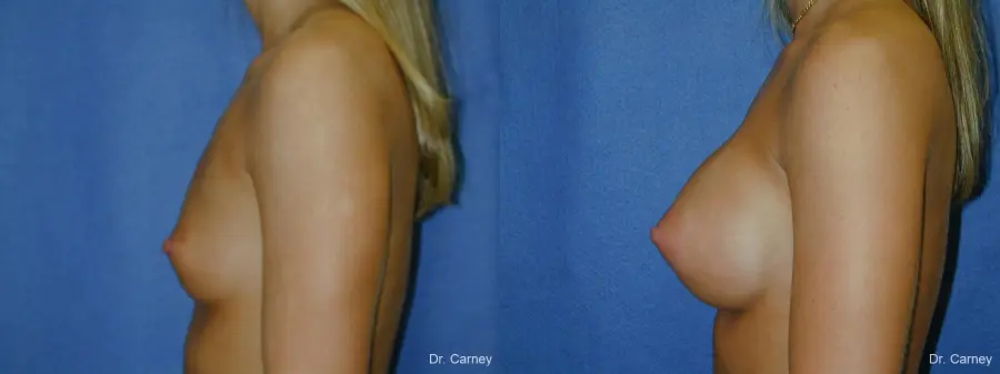Virginia Beach Breast Augmentation 1193 - Before and After 3