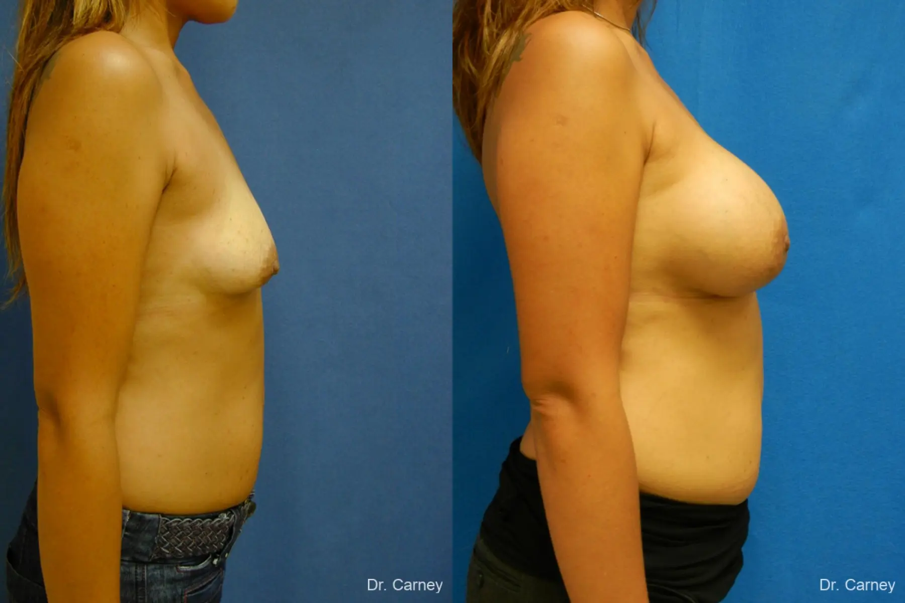 Virginia Beach Breast Augmentation 1860 - Before and After 3