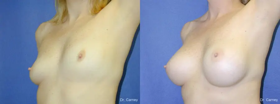 Virginia Beach Breast Augmentation 1084 - Before and After 1