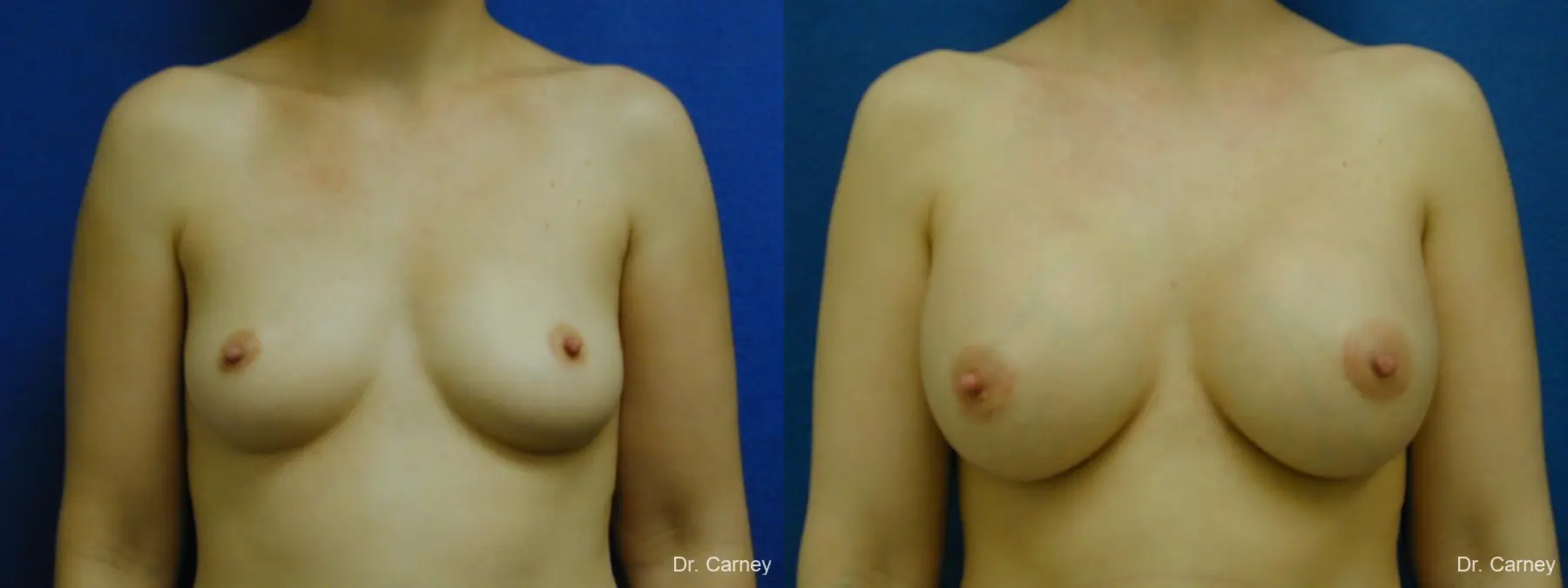 Virginia Beach Breast Augmentation 1086 - Before and After 3