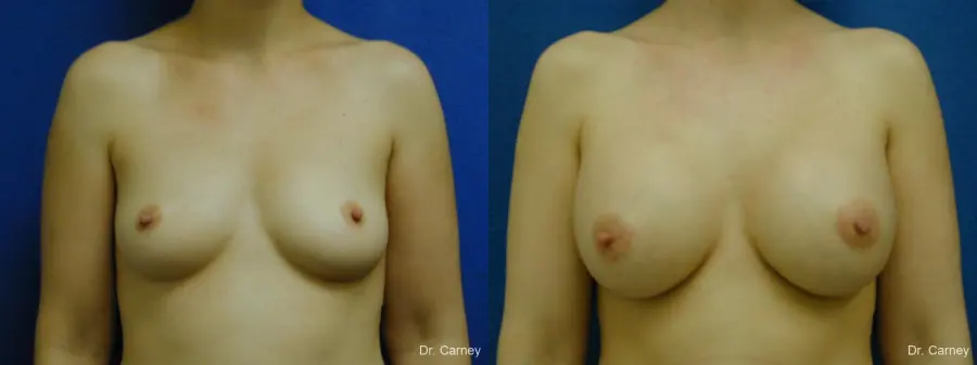 Virginia Beach Breast Augmentation 1086 - Before and After 3