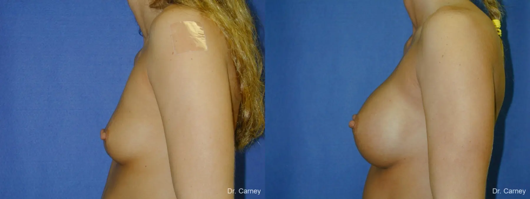 Virginia Beach Breast Augmentation 1097 - Before and After 1