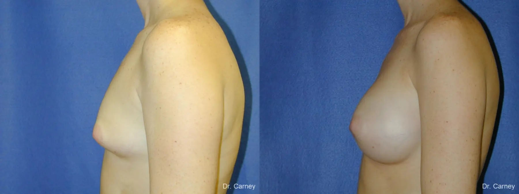Virginia Beach Breast Augmentation 1090 - Before and After