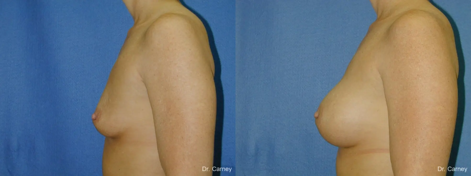 Virginia Beach Breast Augmentation 1081 - Before and After 1