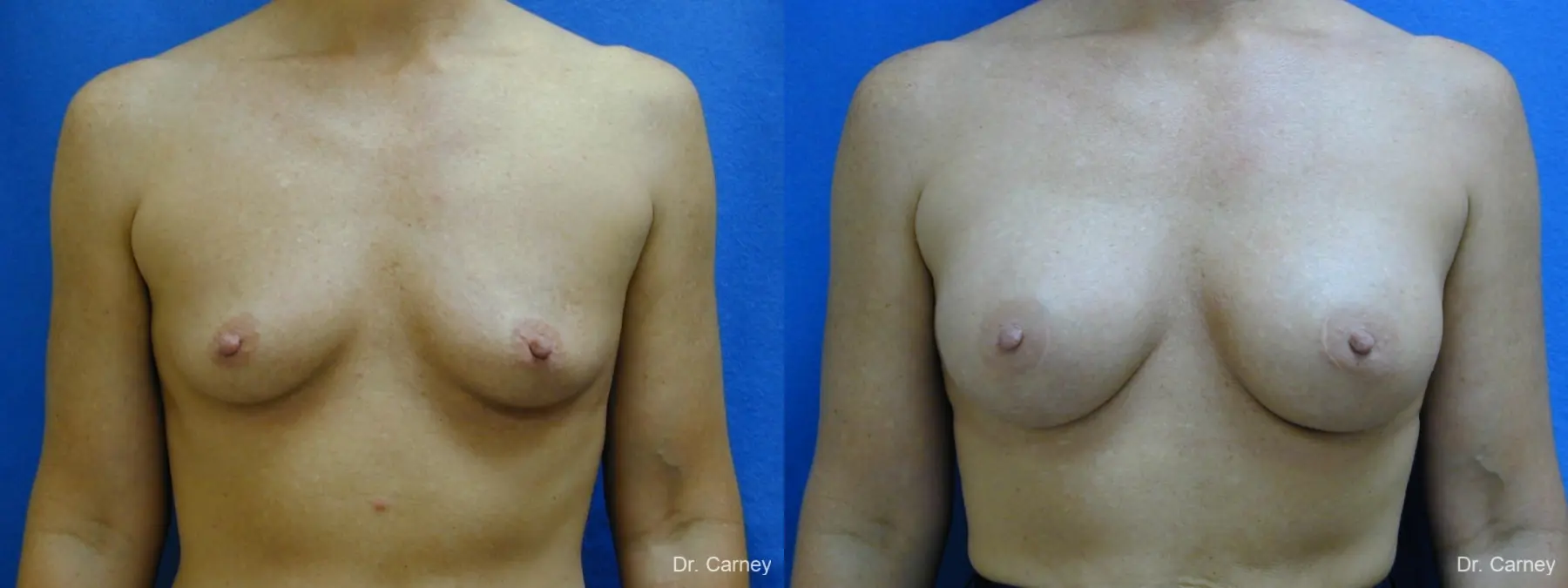 Virginia Beach Breast Augmentation 1214 - Before and After 1
