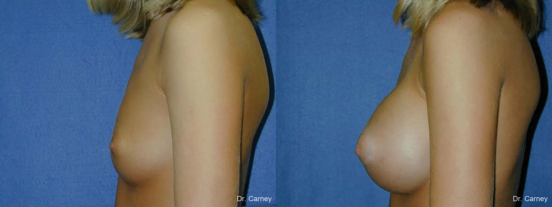 Virginia Beach Breast Augmentation 1092 - Before and After 1