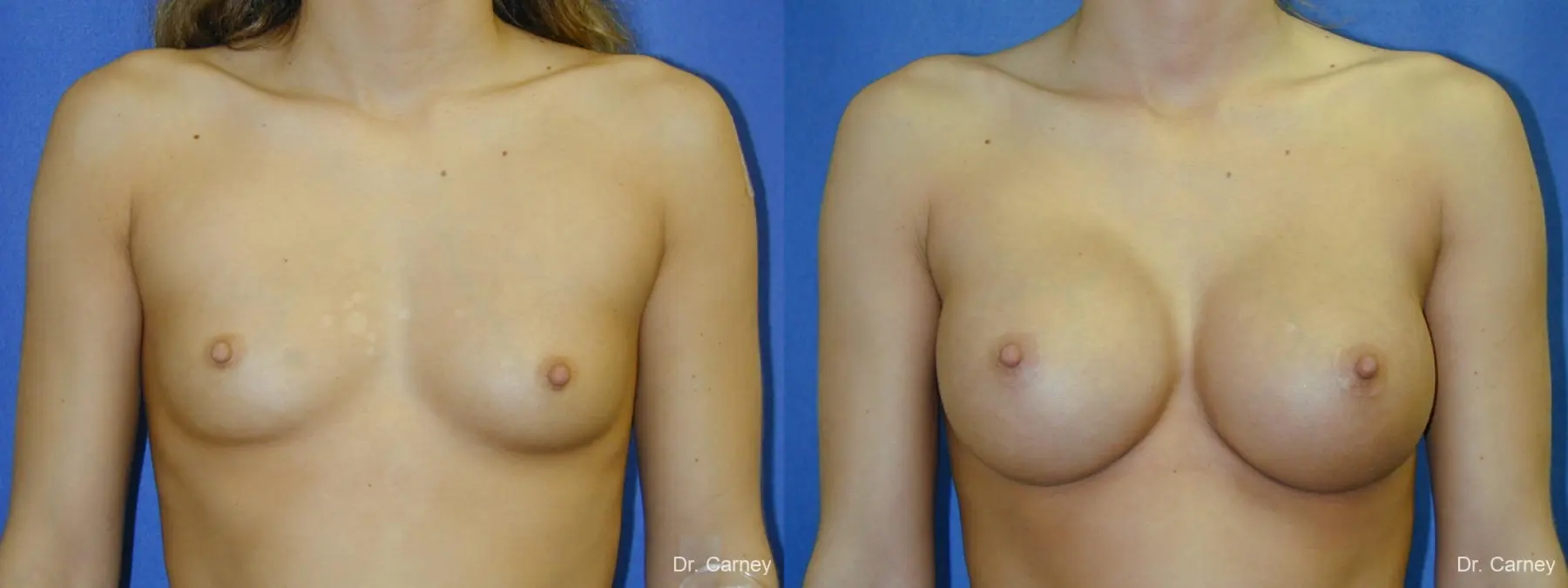 Virginia Beach Breast Augmentation 1097 - Before and After 3