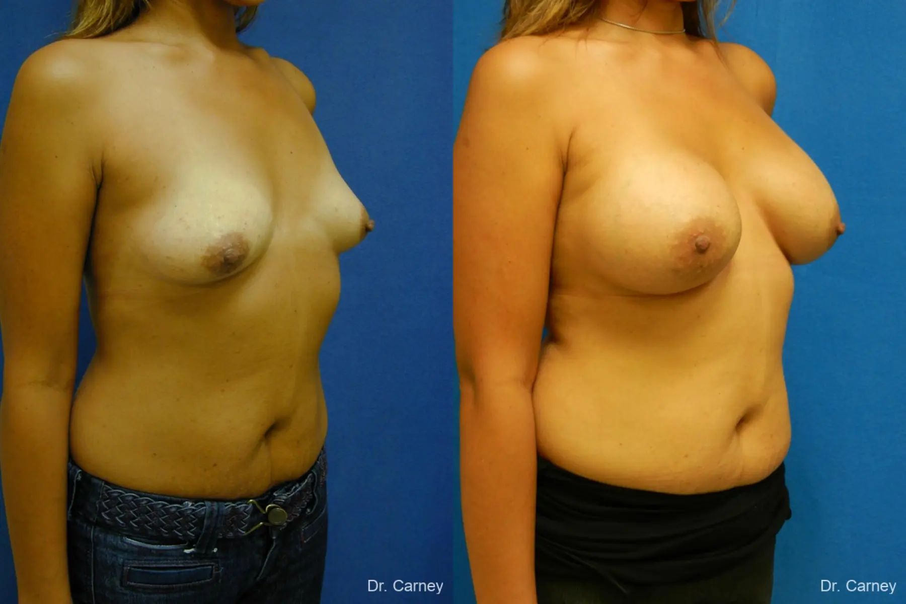 Virginia Beach Breast Augmentation 1860 - Before and After 2