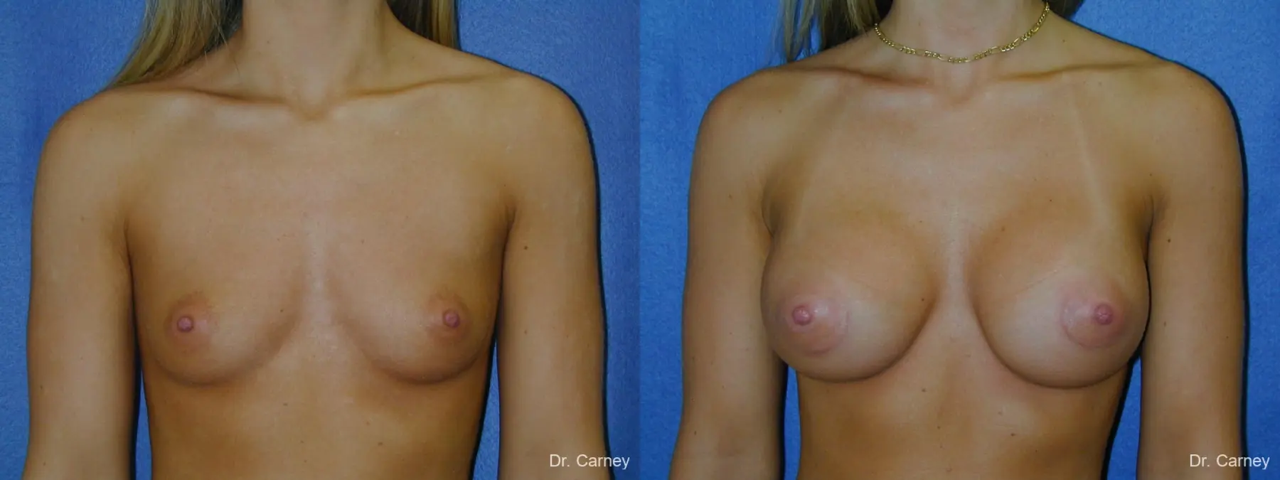 Virginia Beach Breast Augmentation 1193 - Before and After 1