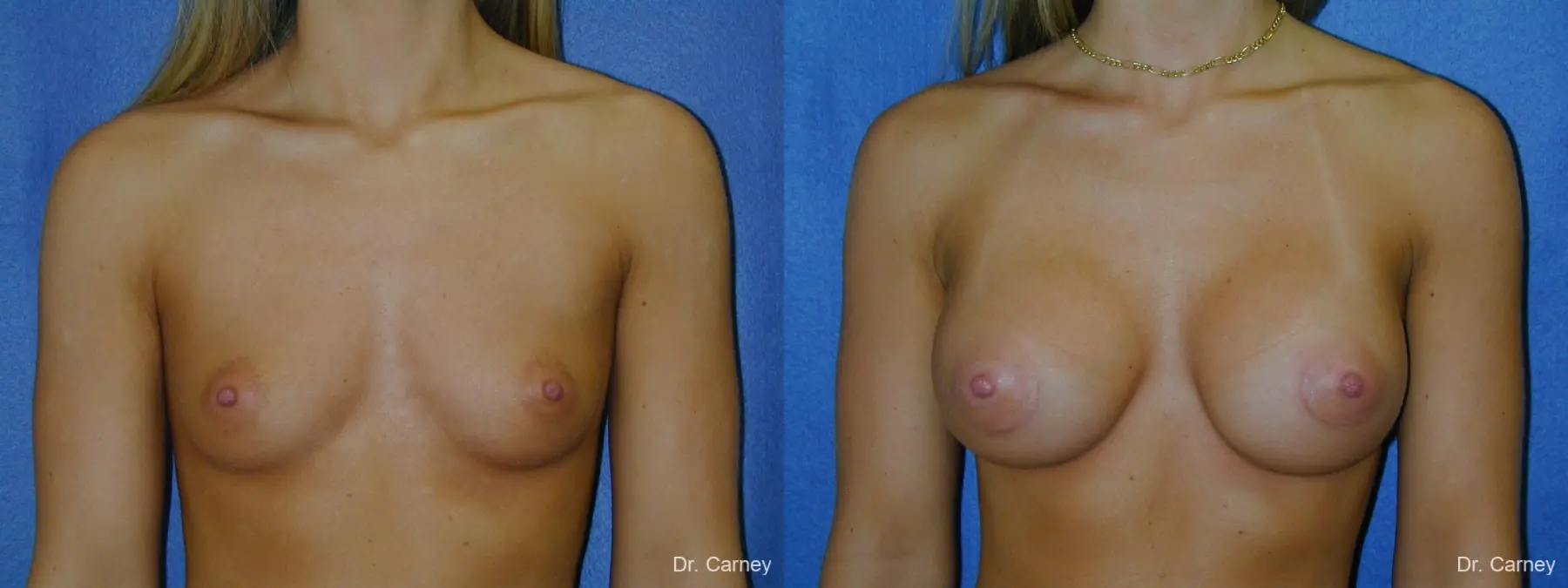 Virginia Beach Breast Augmentation 1193 - Before and After