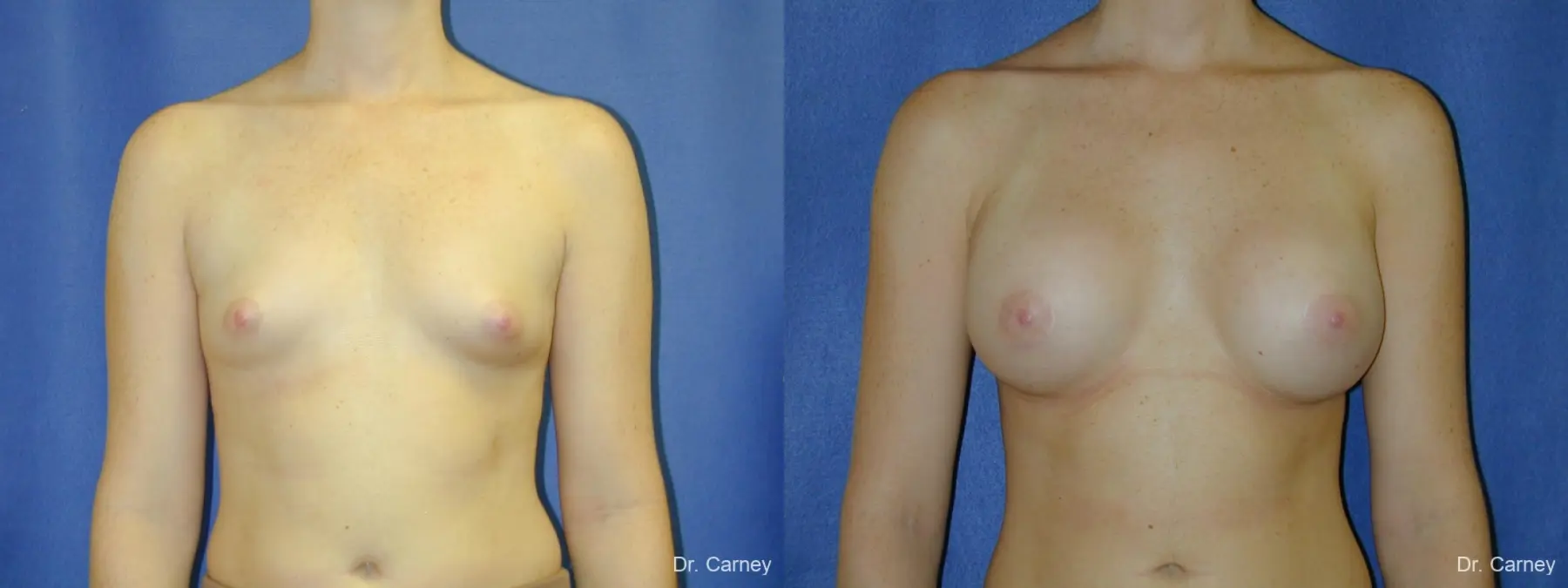 Virginia Beach Breast Augmentation 1090 - Before and After 3