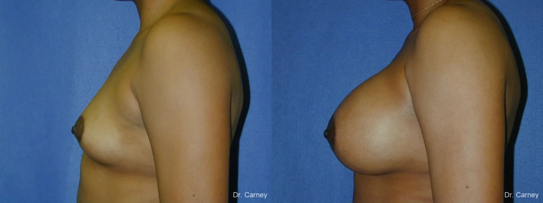 Virginia Beach Breast Augmentation 1091 - Before and After 2