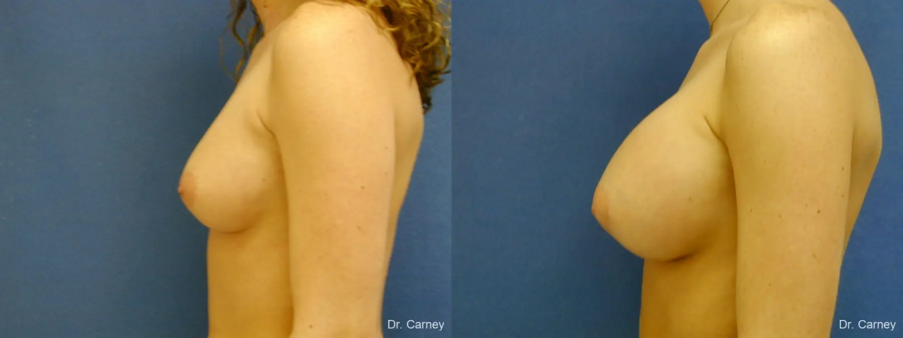 Virginia Beach Breast Augmentation 1089 - Before and After 1