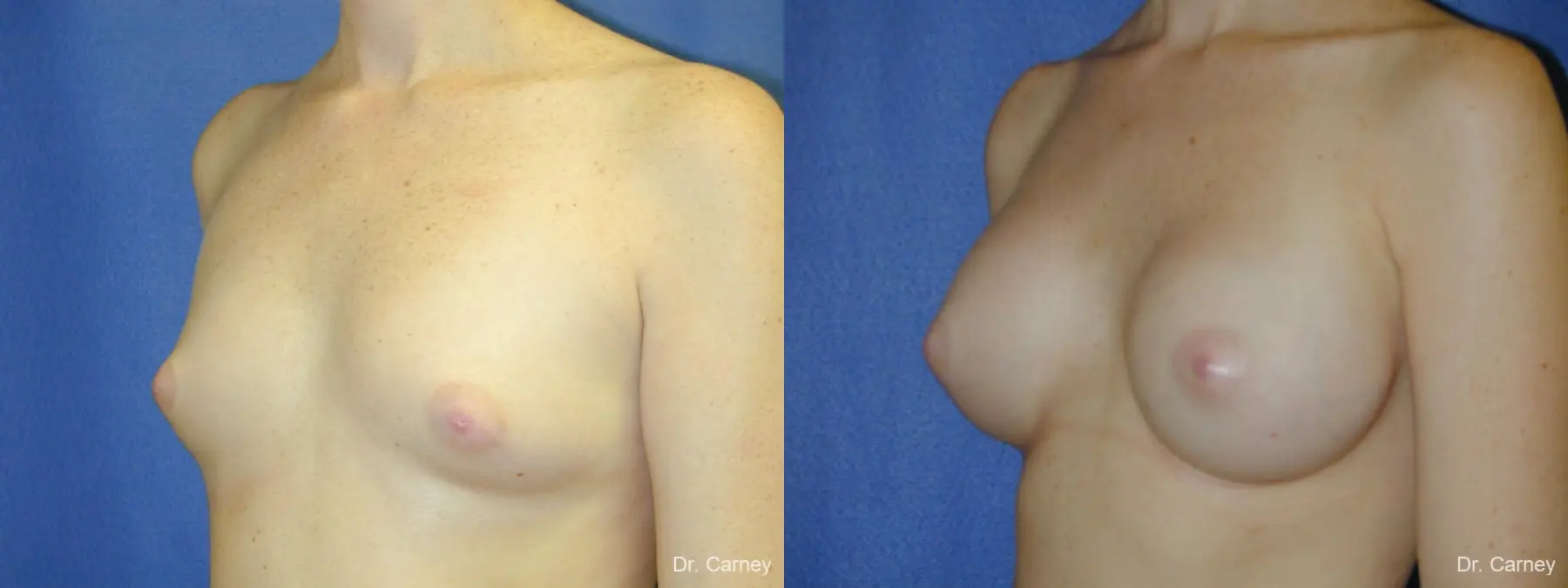 Virginia Beach Breast Augmentation 1090 - Before and After 2