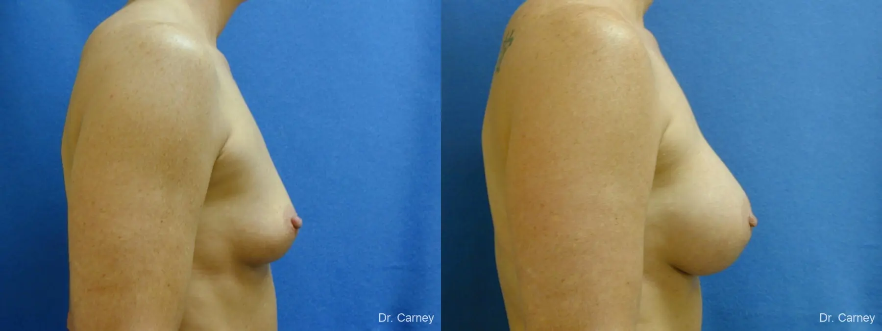 Virginia Beach Breast Augmentation 1214 - Before and After 3