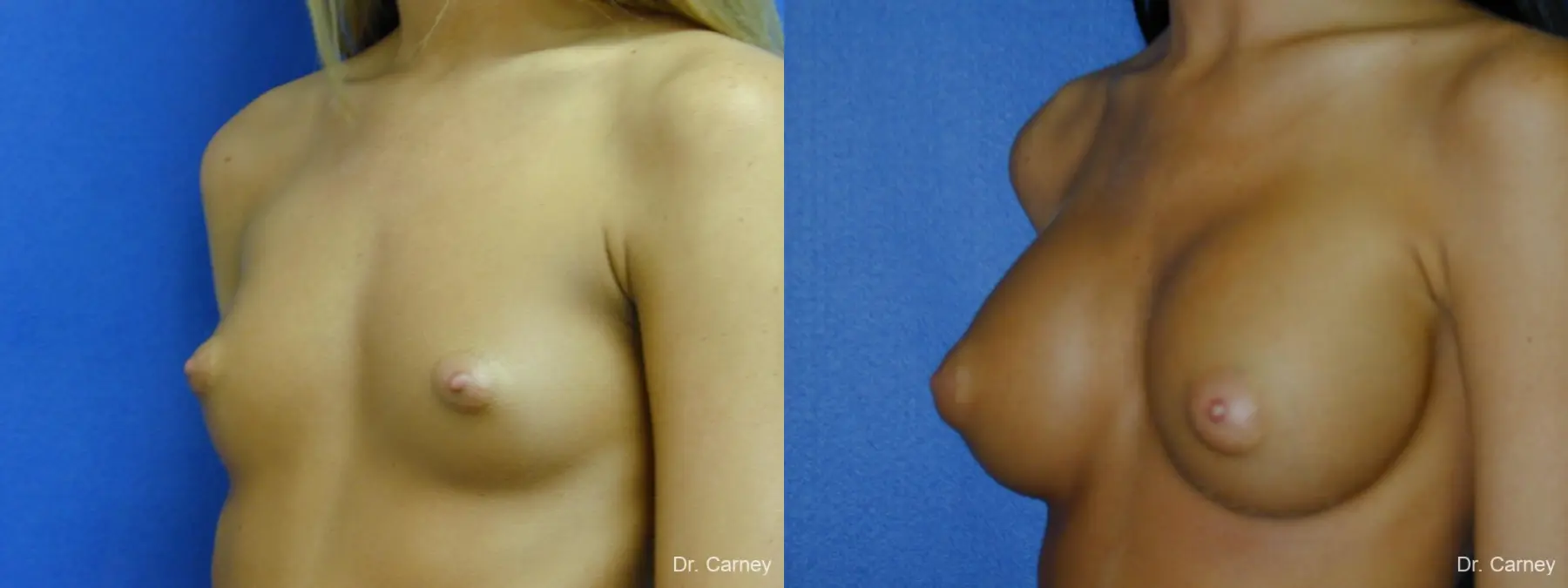 Virginia Beach Breast Augmentation 1082 - Before and After 2
