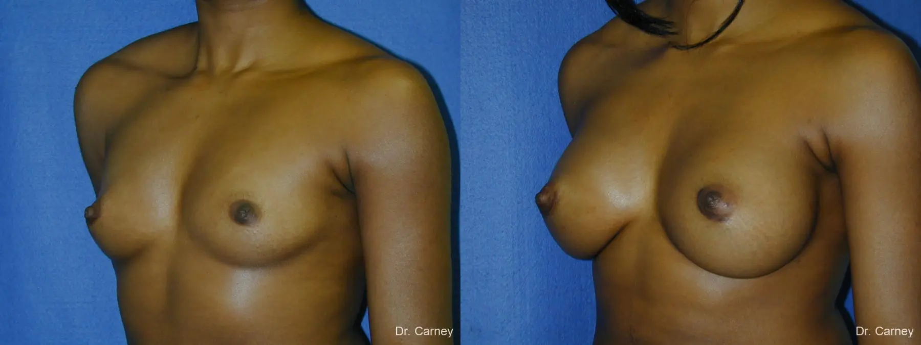 Virginia Beach Breast Augmentation 1085 - Before and After 2