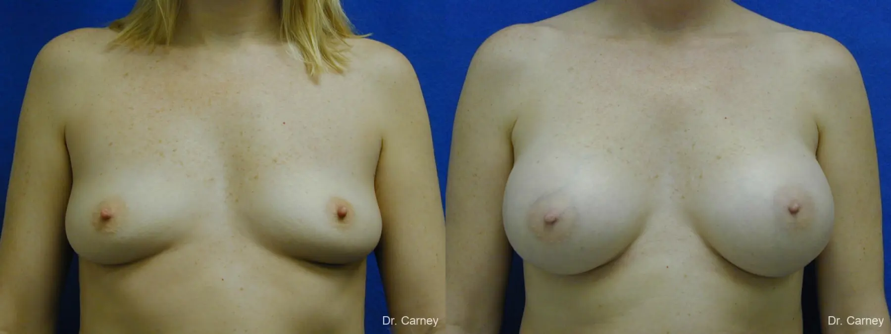 Virginia Beach Breast Augmentation 1084 - Before and After 3