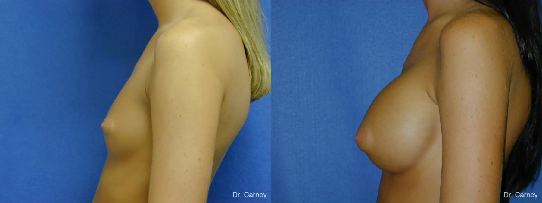 Virginia Beach Breast Augmentation 1082 - Before and After 1