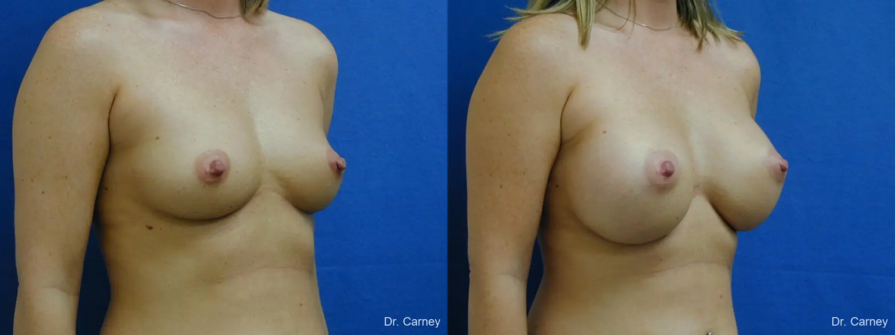 Virginia Beach Breast Augmentation 1192 - Before and After 2