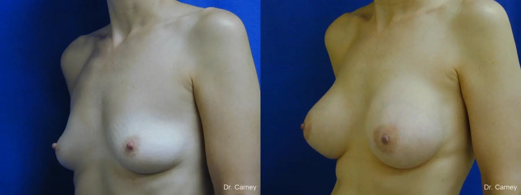 Virginia Beach Breast Augmentation 1088 - Before and After 2