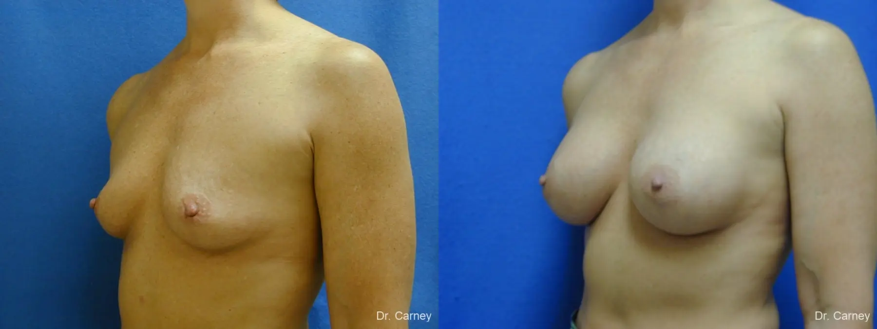 Virginia Beach Breast Augmentation 1214 - Before and After 4