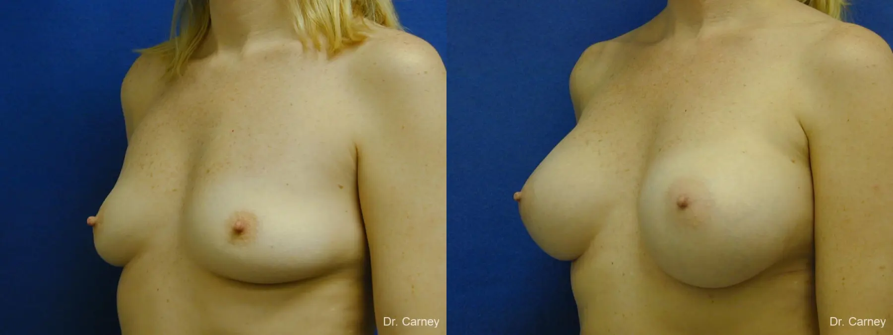 Virginia Beach Breast Augmentation 1084 - Before and After 2