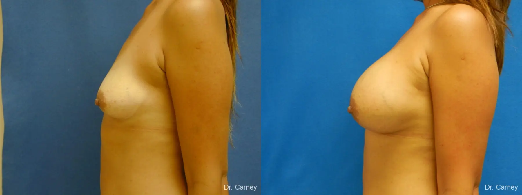 Virginia Beach Breast Augmentation 1860 - Before and After 5