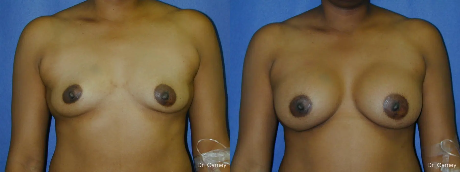 Virginia Beach Breast Augmentation 1091 - Before and After