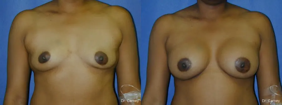 Virginia Beach Breast Augmentation 1091 - Before and After 1