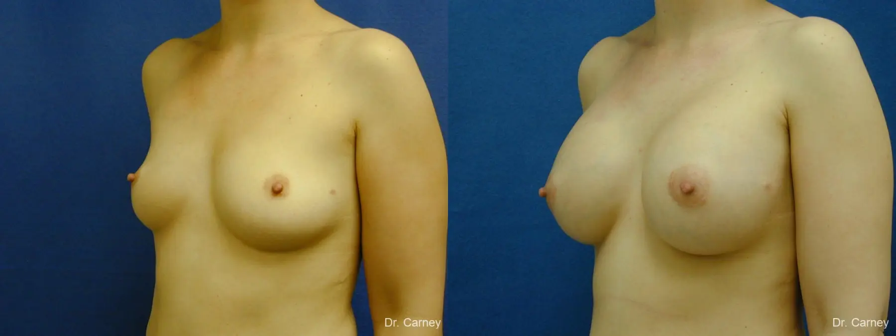 Virginia Beach Breast Augmentation 1086 - Before and After 2