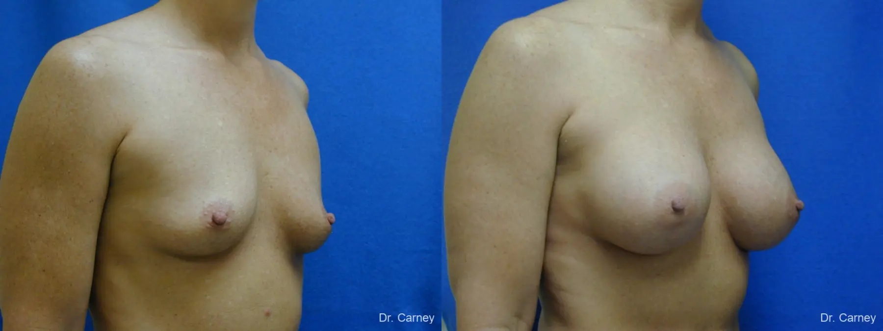Virginia Beach Breast Augmentation 1214 - Before and After 2