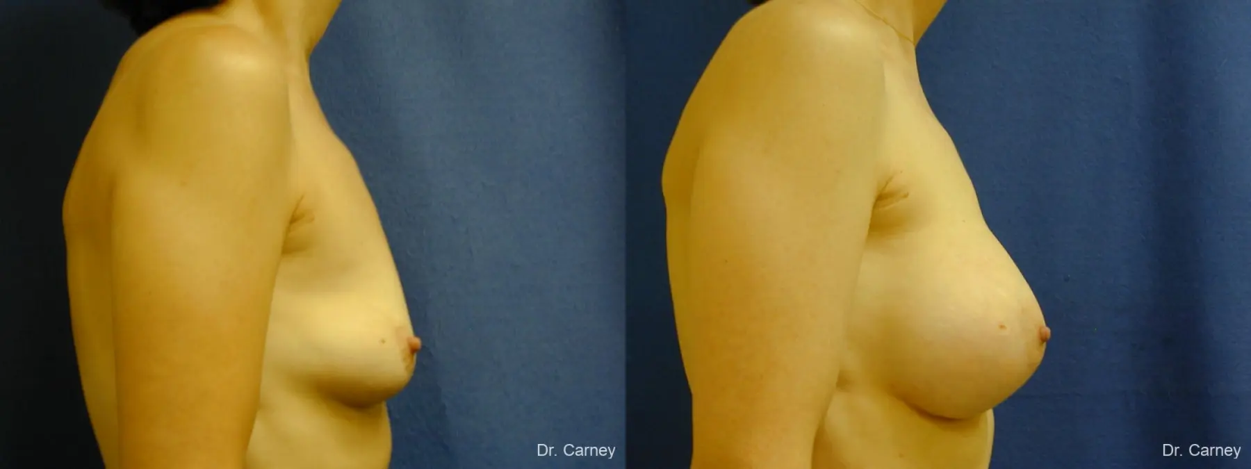 Virginia Beach Breast Augmentation 1088 - Before and After 1