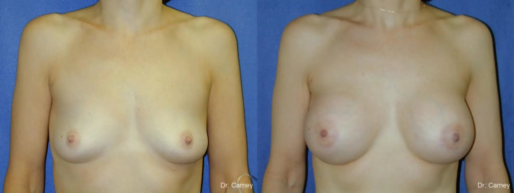 Virginia Beach Breast Augmentation 1088 - Before and After 3