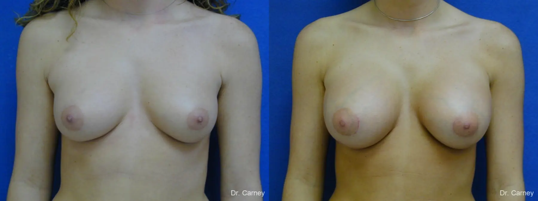 Virginia Beach Breast Augmentation 1089 - Before and After 3