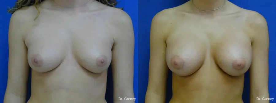 Virginia Beach Breast Augmentation 1089 - Before and After 3