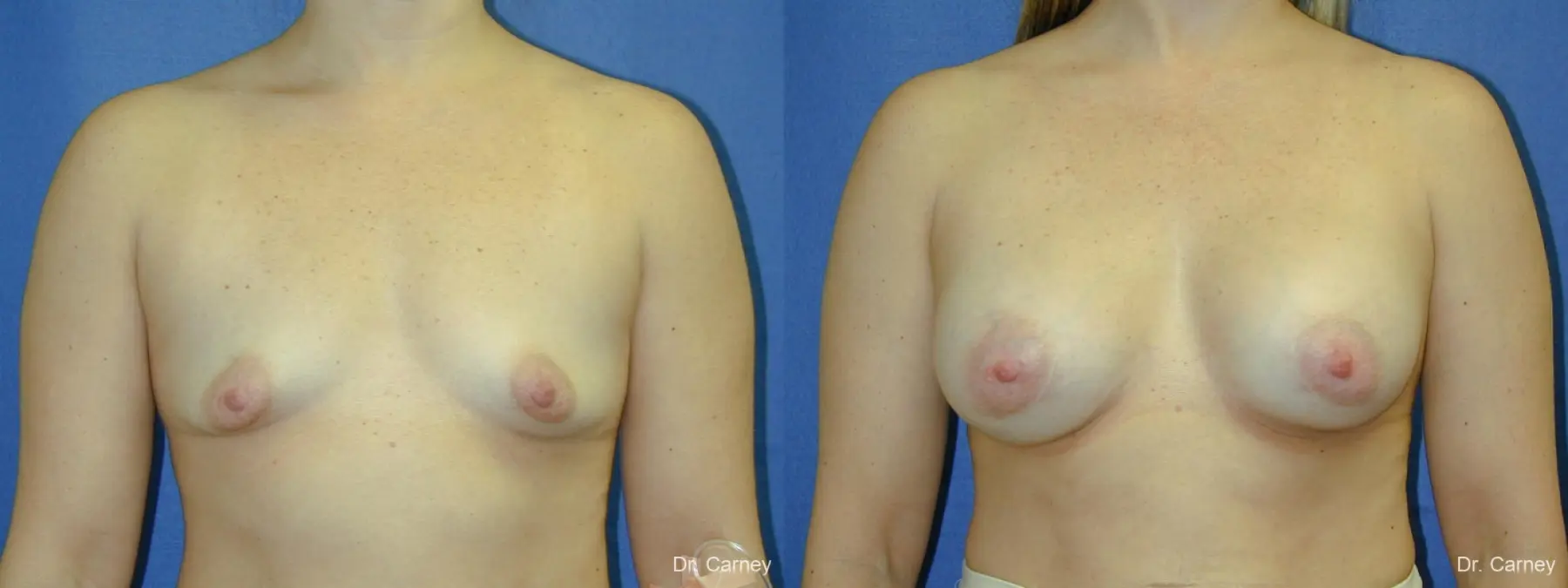 Virginia Beach Breast Augmentation 1083 - Before and After 3