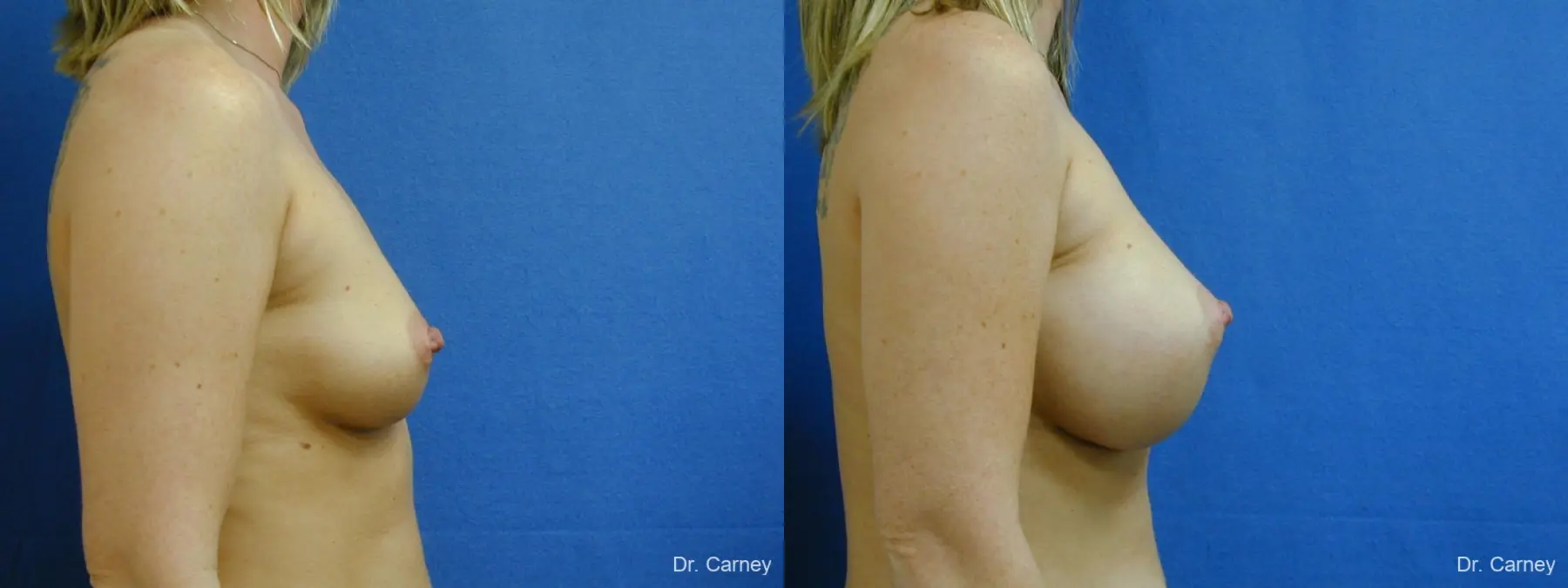 Virginia Beach Breast Augmentation 1192 - Before and After 3