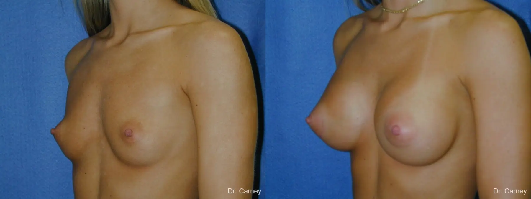 Virginia Beach Breast Augmentation 1080 - Before and After 2