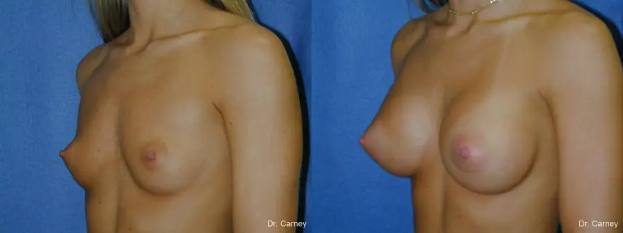 Virginia Beach Breast Augmentation 1080 - Before and After 2