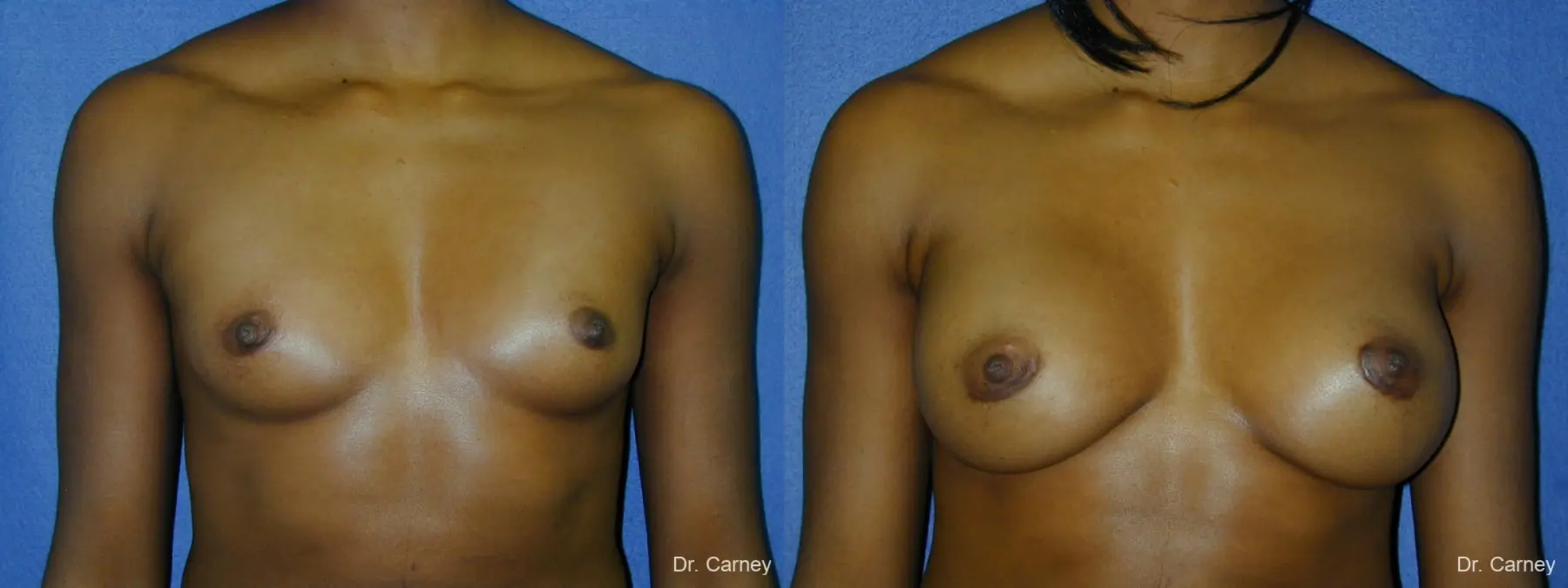 Virginia Beach Breast Augmentation 1085 - Before and After 3