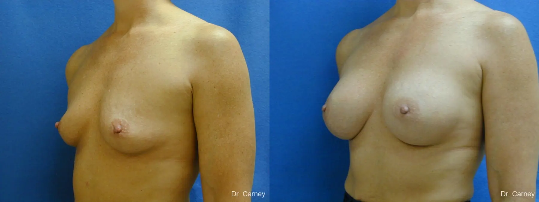 Virginia Beach Breast Augmentation 1081 - Before and After 2